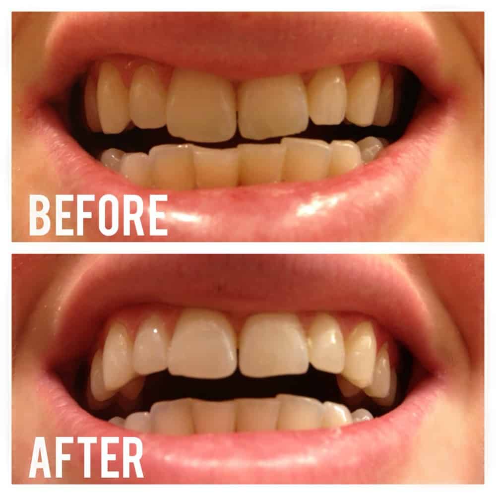 hydrogen peroxide teeth before and after
